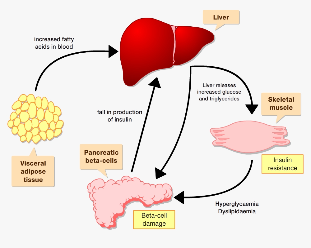 Obesity Diabetes Link